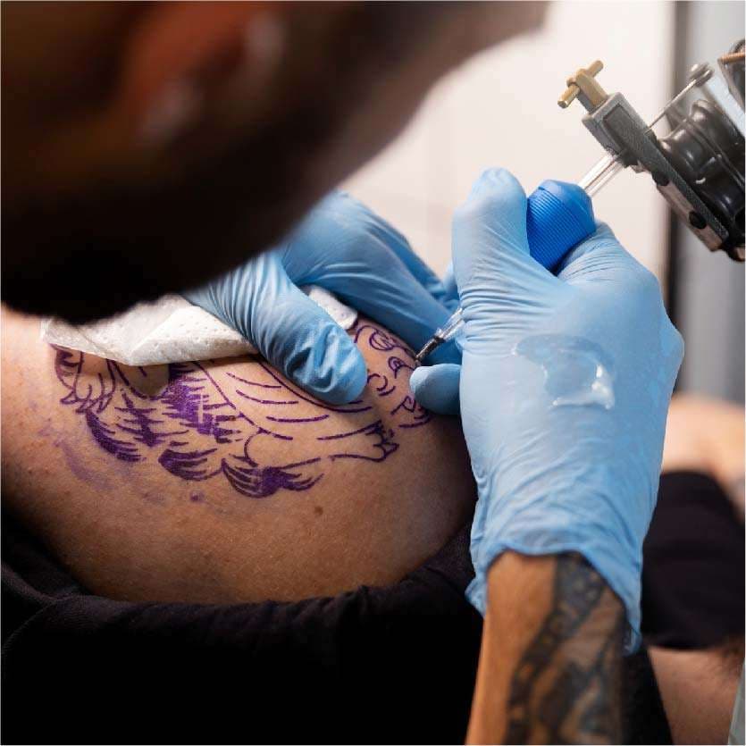 Tattoo Removal