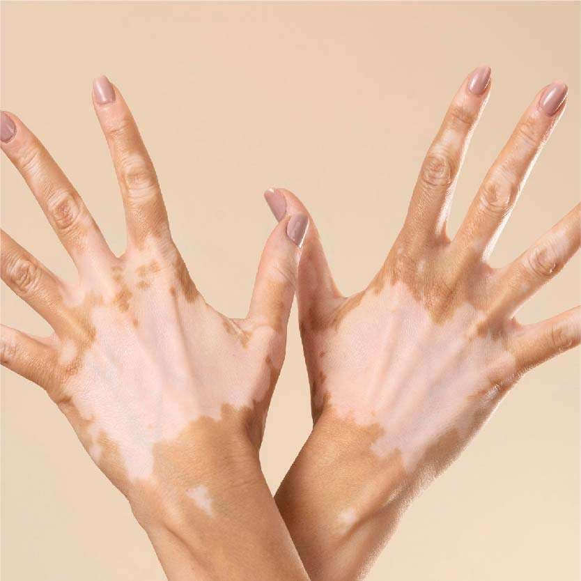 Best Vitiligo Surgery in Indore